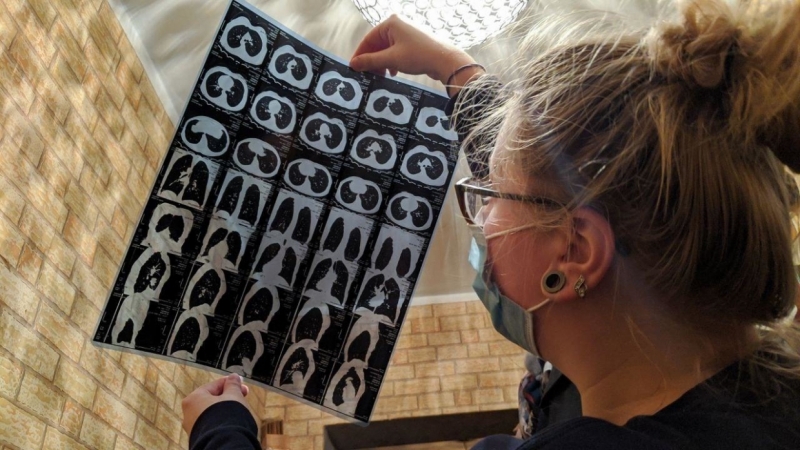 Шведские медики раскрыли влияние лишнего веса на мозг